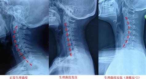 反弓|颈椎反弓怎么办？